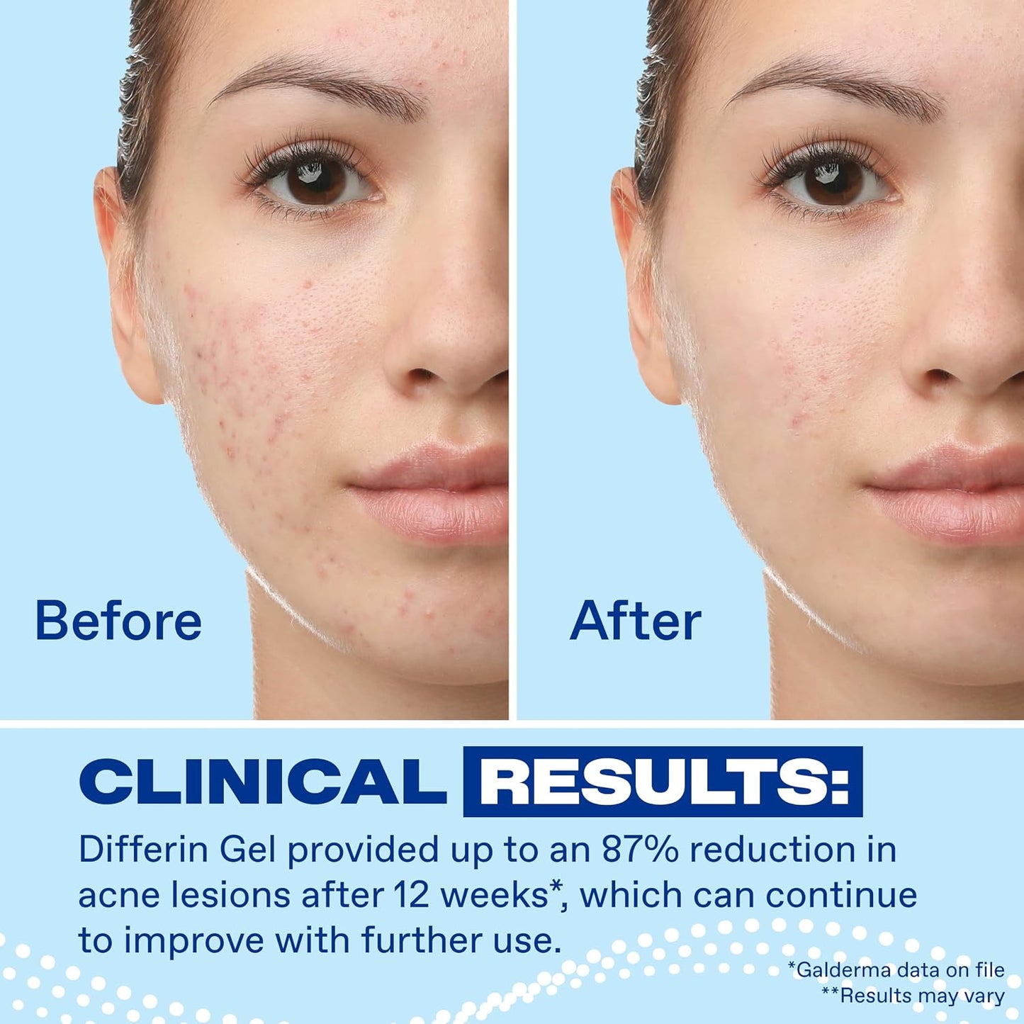 HotDifferin Acne Treatment Gel, 90 Day Supply, Retinoid Treatment for Face with 0.1% Adapalene, Gentle Skin Care for Acne Prone Sensitive Skin, 45g Pump (Packaging May Vary)