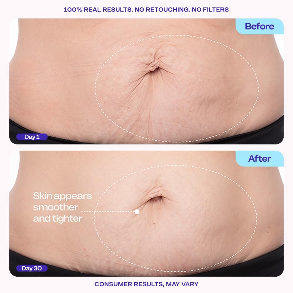 HotGOPURE Tighten & Smooth Belly Cream - Clinically Tested with MicroTight4 Complex to Reduce the Appearance of Cellulite & Stretch Marks - Quick Absorbing for Smoother, Firmer-Looking Skin, 4.25oz
