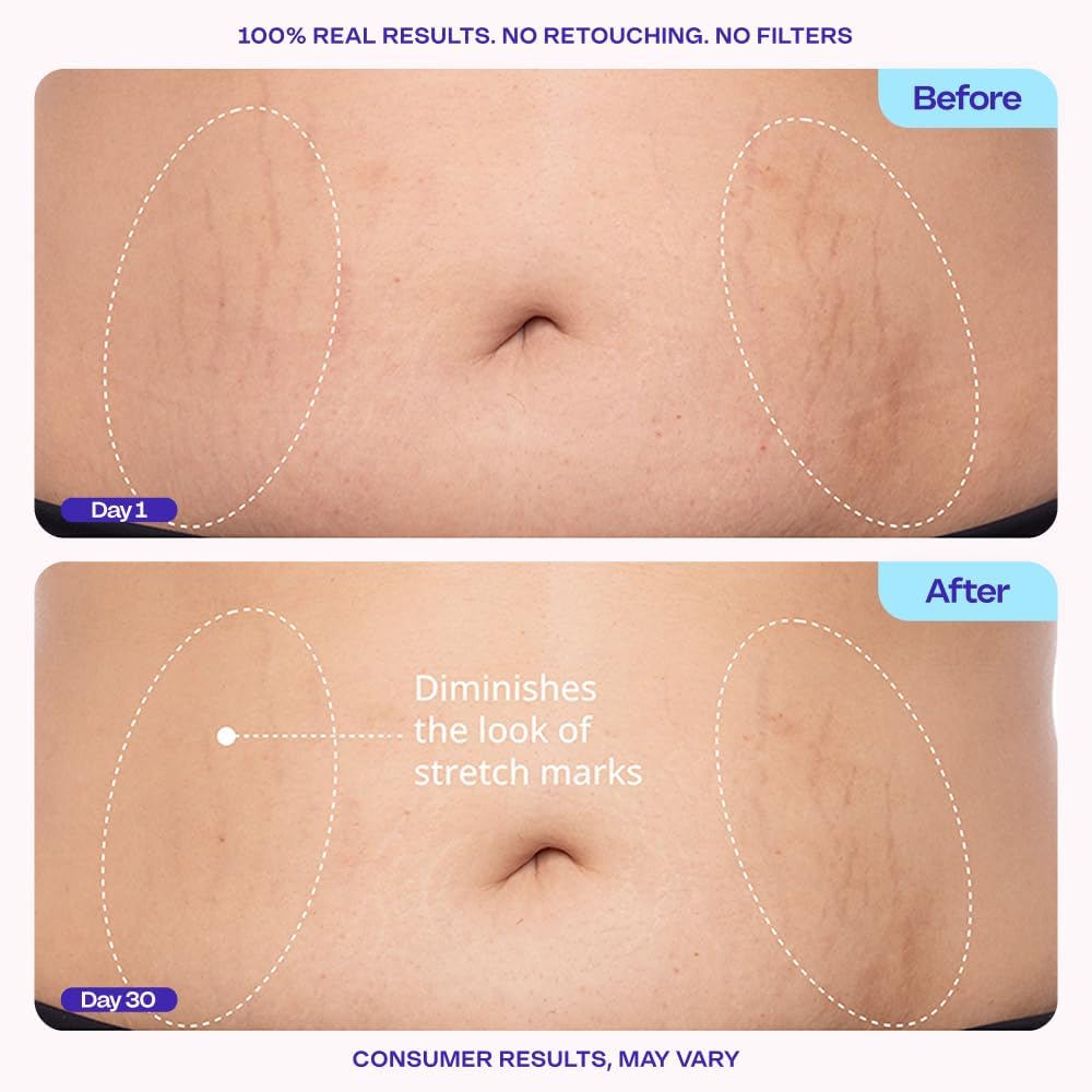 HotGOPURE Tighten & Smooth Belly Cream - Clinically Tested with MicroTight4 Complex to Reduce the Appearance of Cellulite & Stretch Marks - Quick Absorbing for Smoother, Firmer-Looking Skin, 4.25oz