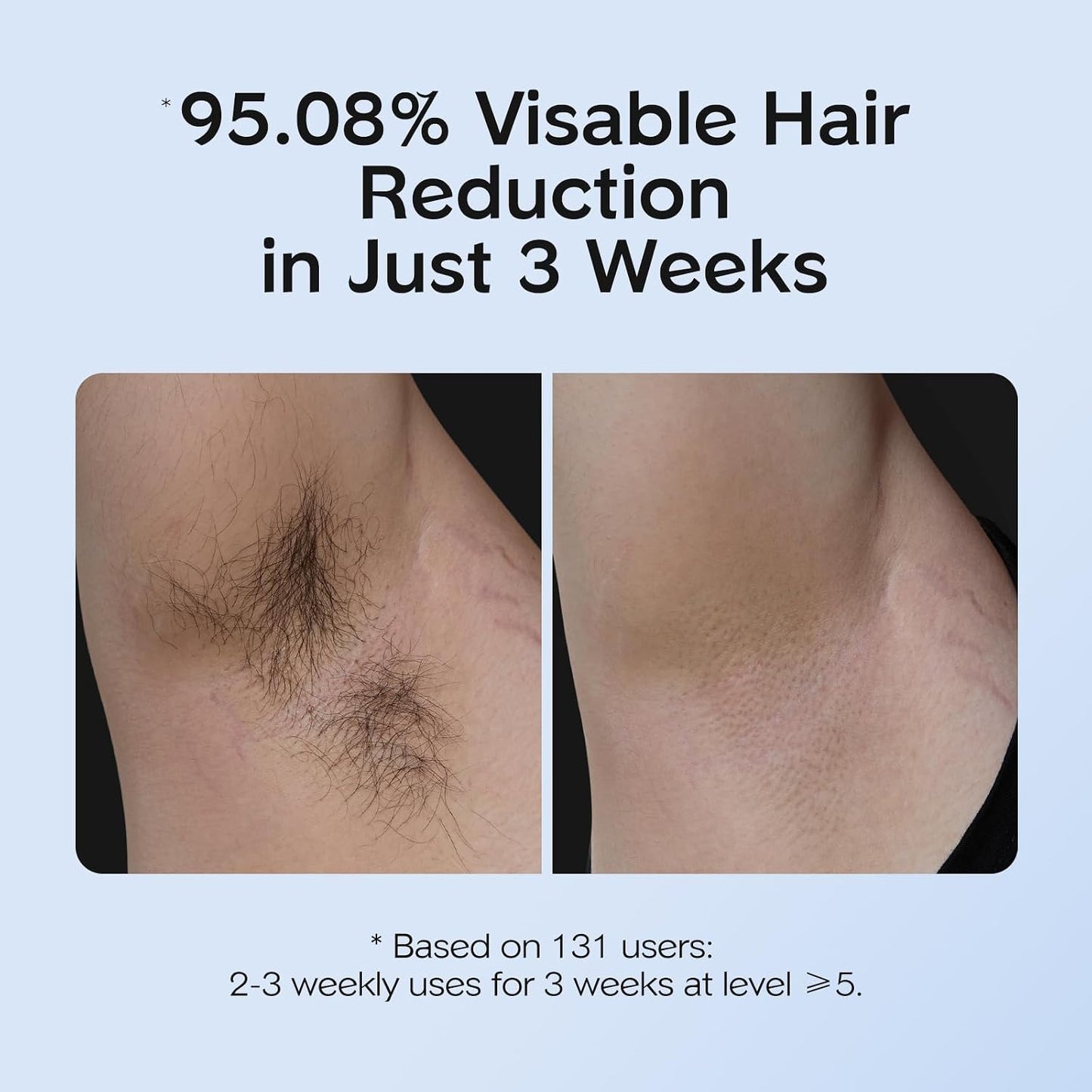 HotINNZA IPL Hair Removal with Ice Cooling Care Function for Women,Long-Lasting Results,999,999 Flashes Painless Hair Removal, Hair Removal Device for Armpits Legs Arms Bikini Line