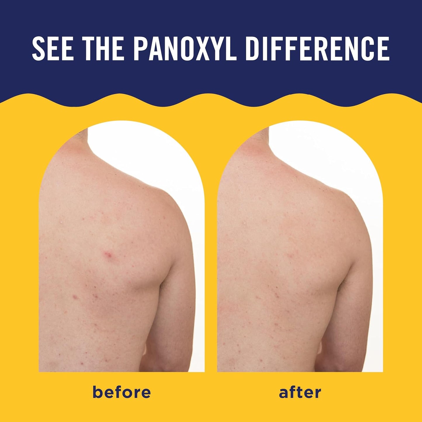 HotPanOxyl Acne Banishing Body Spray with 2% Salicylic Acid, Pimple Treatment Spray to Clear Stubborn Breakouts, 360-Degree Spray Nozzle, Skin-Brightening Niacinamide, Vitamin C, Witch Hazel, Aloe, 6 Oz