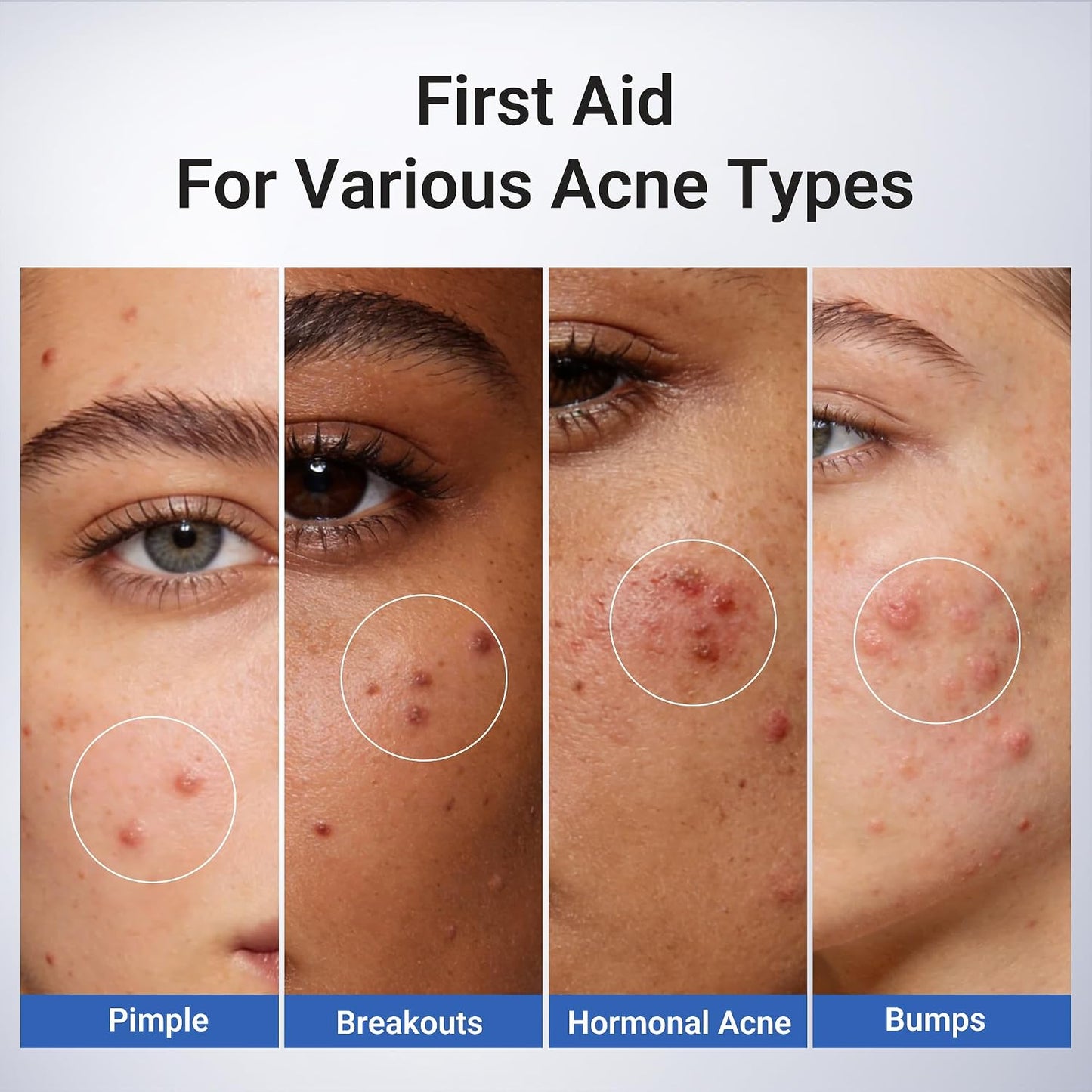 Hot1.8% Salicylic Acid Acne Treatment, Drying Lotion Acne Spot Treatment for Acne-Prone Sensitive Skin | Niacinamide, Fast Pimple Relief, Fades Acne Marks, Overnight & Period Breakouts, 0.34 fl oz