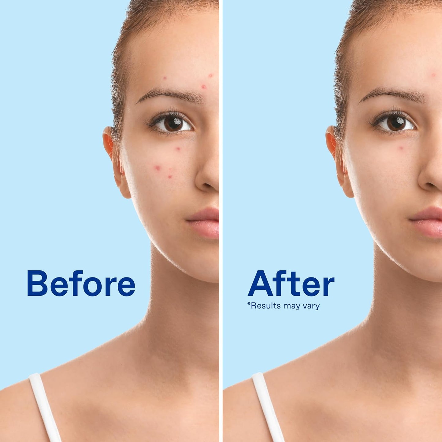 HotDifferin Acne Face Wash with 10% Benzoyl Peroxide, Maximum Strength OTC Acne Foaming Cleanser, Fast Acting Acne Treatment for Face and Body, 5 oz.