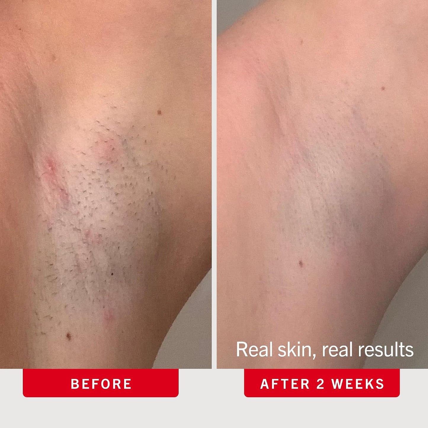 HotFirst Aid Beauty Ingrown Hair Pads Aftershave Treatment to Help Prevent Razor Bumps, Exfoliate Underarms & Bikini Area, Sensitive Skin
