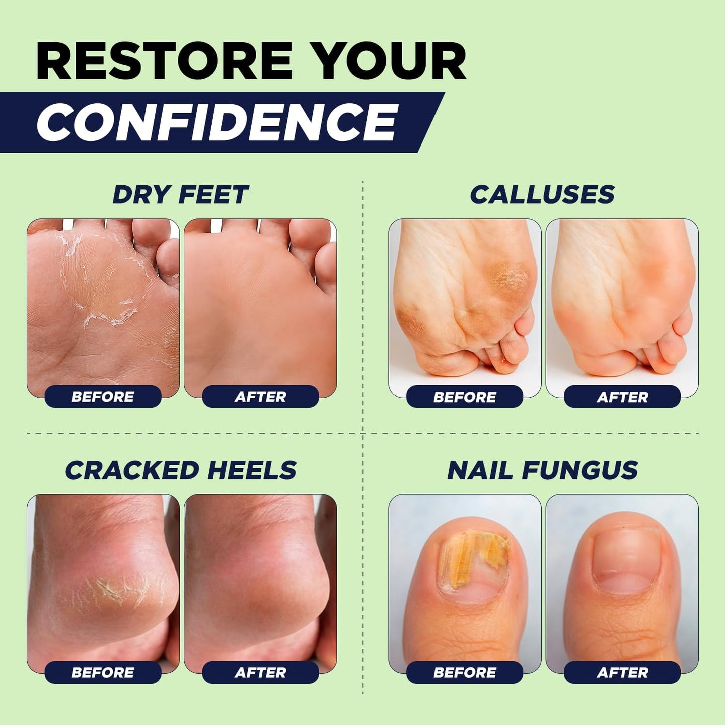 HotTea Tree Oil Foot Soak with Epsom Salt - For Toenail Repair, Athletes Foot, Softens Calluses, Soothes Sore & Tired Feet, Nail Discoloration, odor Scent, Spa Pedicure Care - Made in USA 16 oz
