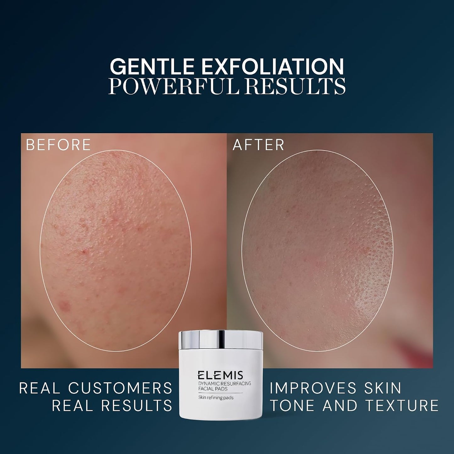 HotELEMIS Dynamic Resurfacing Facial Pads, Gentle Textured Treatment Facial Exfoliating Pads