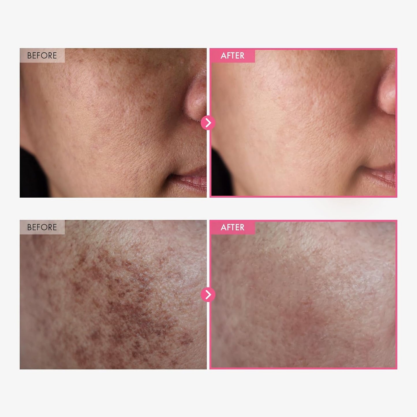 HotTOSOWOONG Arbutin 7% + Tranexamic Acid 4% Cream, 70,000ppm Arbutin, 40,000ppm TXA, Niacinamide, Glutathione, Dark Spots, Freckle, Blemishes, Pigmentation, Korean Skin Care, 50ml, 1.69 fl.oz.