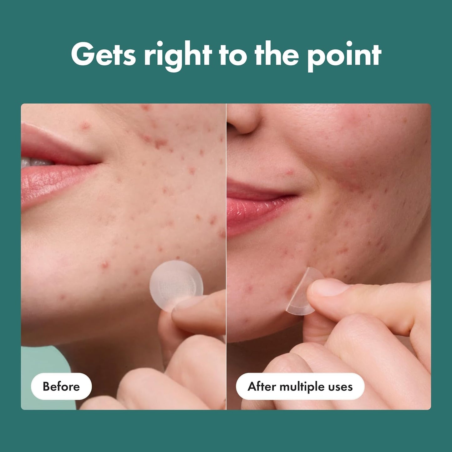 HotMighty Patch Hero Cosmetics Micropoint Acne Pimple Patches, 8 Ct | For Early Stage Zits & Hidden Blemishes; Hydrocolloid with Salicylic Acid, Niacinamide, Cica; 395 Micropoints; Acne Stickers