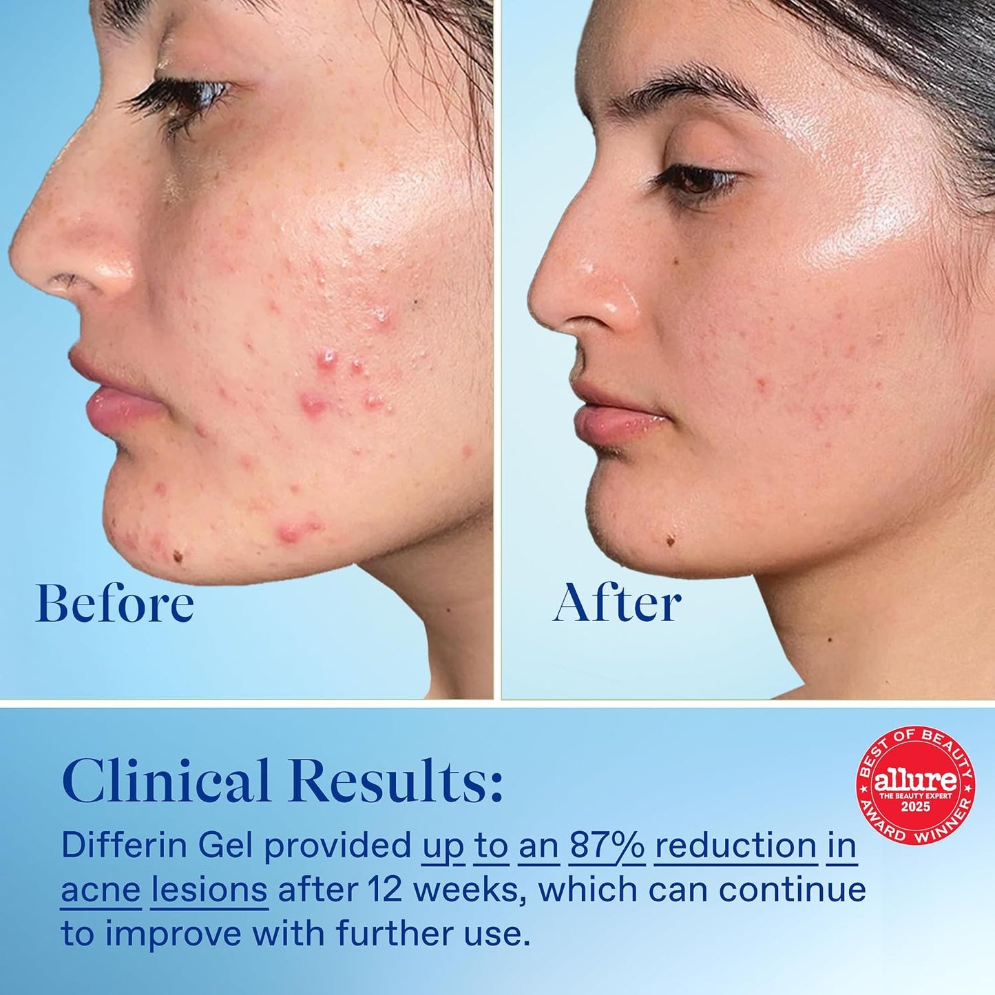 HotDifferin Acne Treatment Gel, 60 Day Supply, Retinoid Treatment for Face with 0.1% Adapalene, Gentle Skin Care for Acne Prone Sensitive Skin, 15g Tube (Pack of 2) (Packaging May Vary) | Pack Of 2, 60-Day Supply, OTC Retinoid, Clears Breakouts, Gentle On