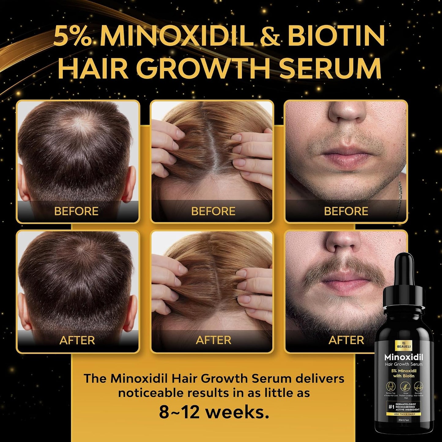 Hotbeaueli 5% Minoxidil for Men & Women Hair Growth, Beard Growth, Hair Loss Treatment, Unisex Adult 1oz