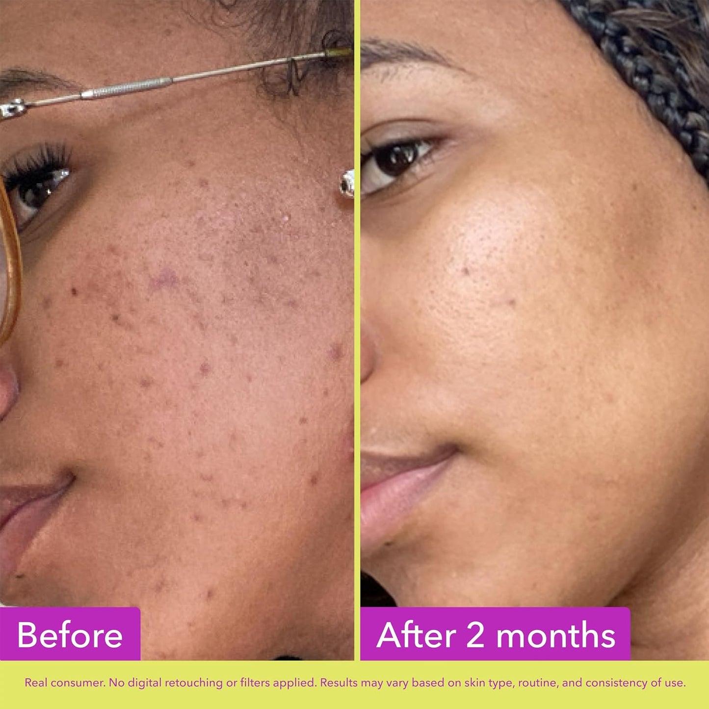HotGood Molecules 10% Azelaic Acid Treatment for Face – Blurs Facial Redness & Evens Skin Tone – Brightens the Look of Dark Spots & Refines Texture – Vegan & Fragrance-Free Skincare (30ml / 1.01 fl oz.)
