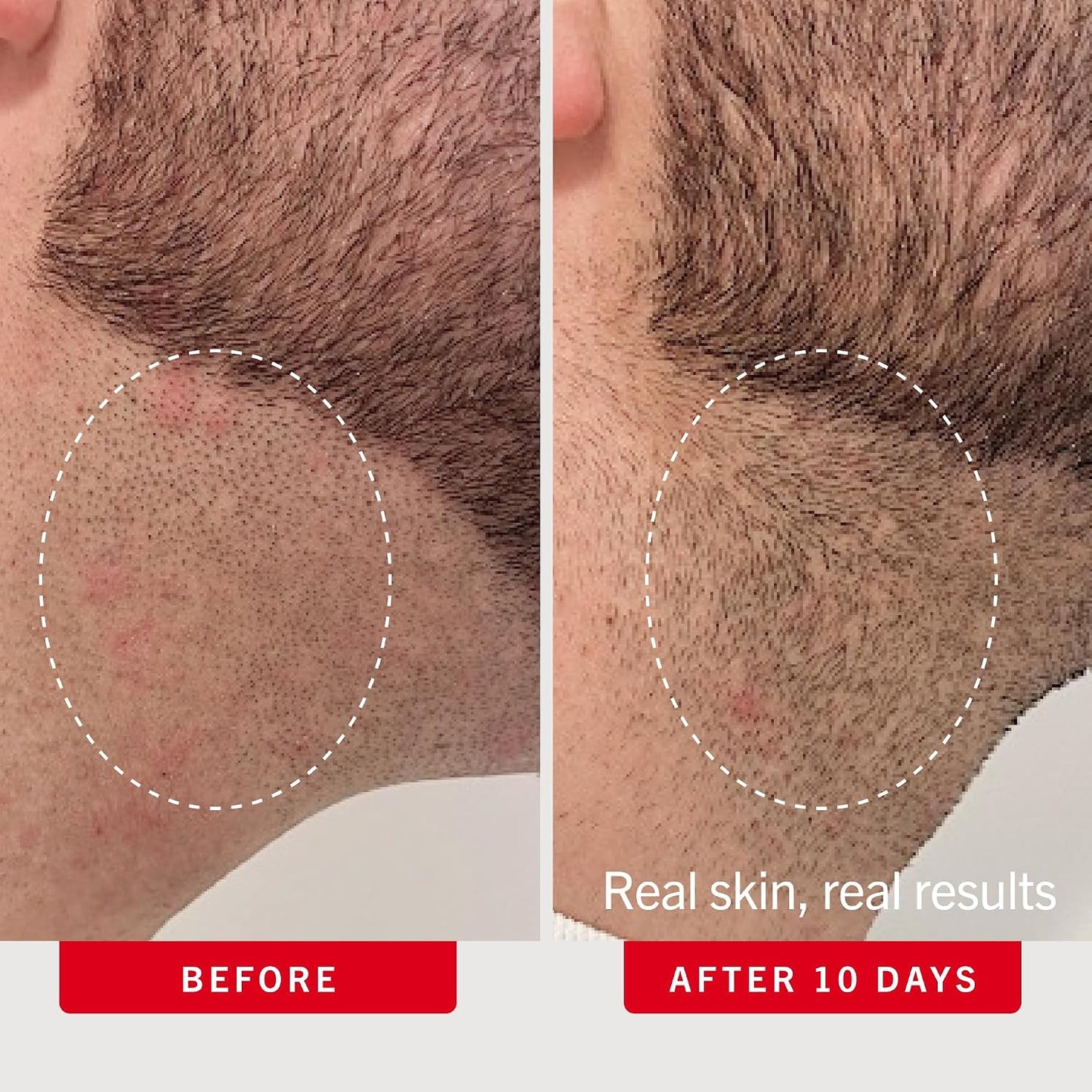 HotFirst Aid Beauty Ingrown Hair Pads Aftershave Treatment to Help Prevent Razor Bumps, Exfoliate Underarms & Bikini Area, Sensitive Skin