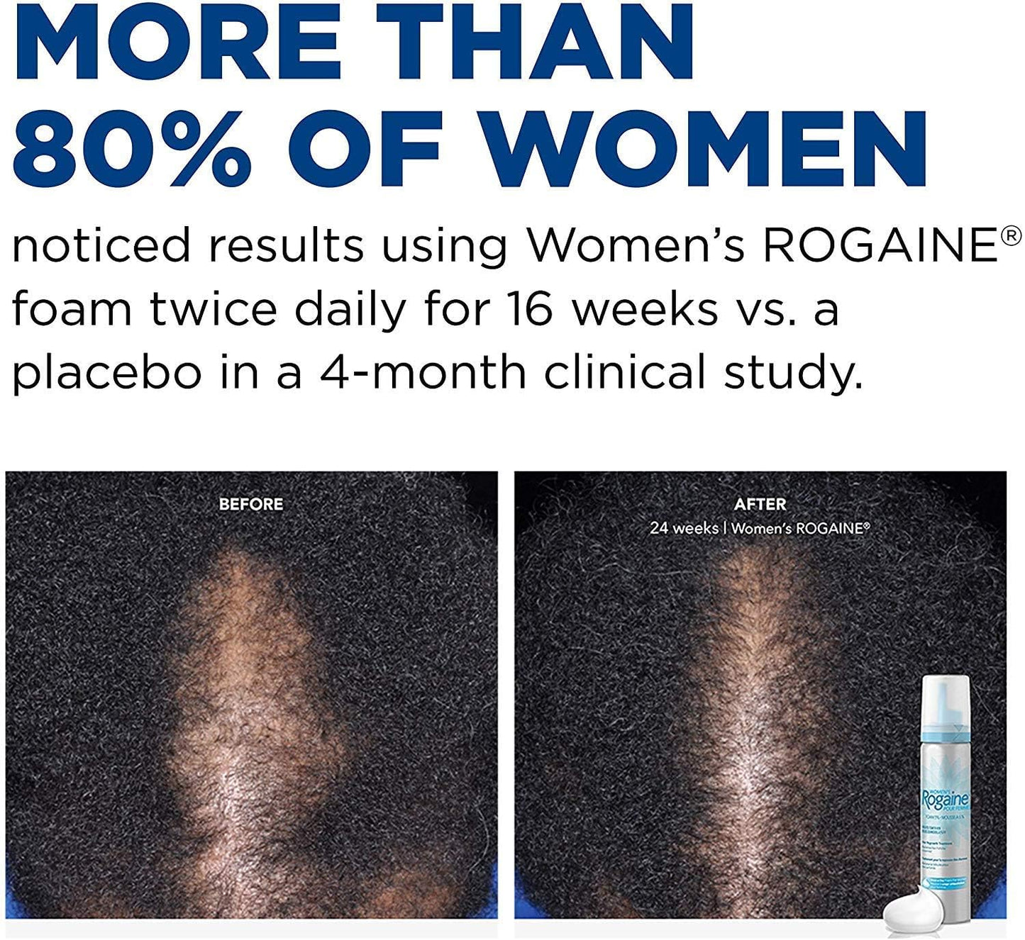 HotRogaine 5% Minoxidil Foam, Topical Once-A-Day Hair Loss Treatment for Women to Regrow Fuller, Thicker Hair, Unscented, 2-Month Supply, 2.11 oz