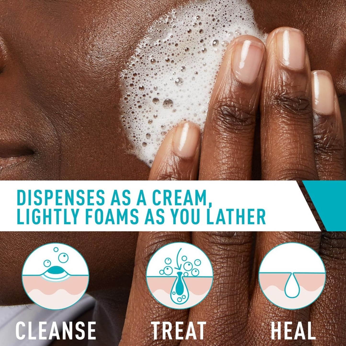 HotCeraVe Acne Foaming Cream Cleanser, 4% Benzoyl Peroxide Face Wash With Hyaluronic Acid, Niacinamide & Ceramides, Gentle Daily Acne Treatment For Face
