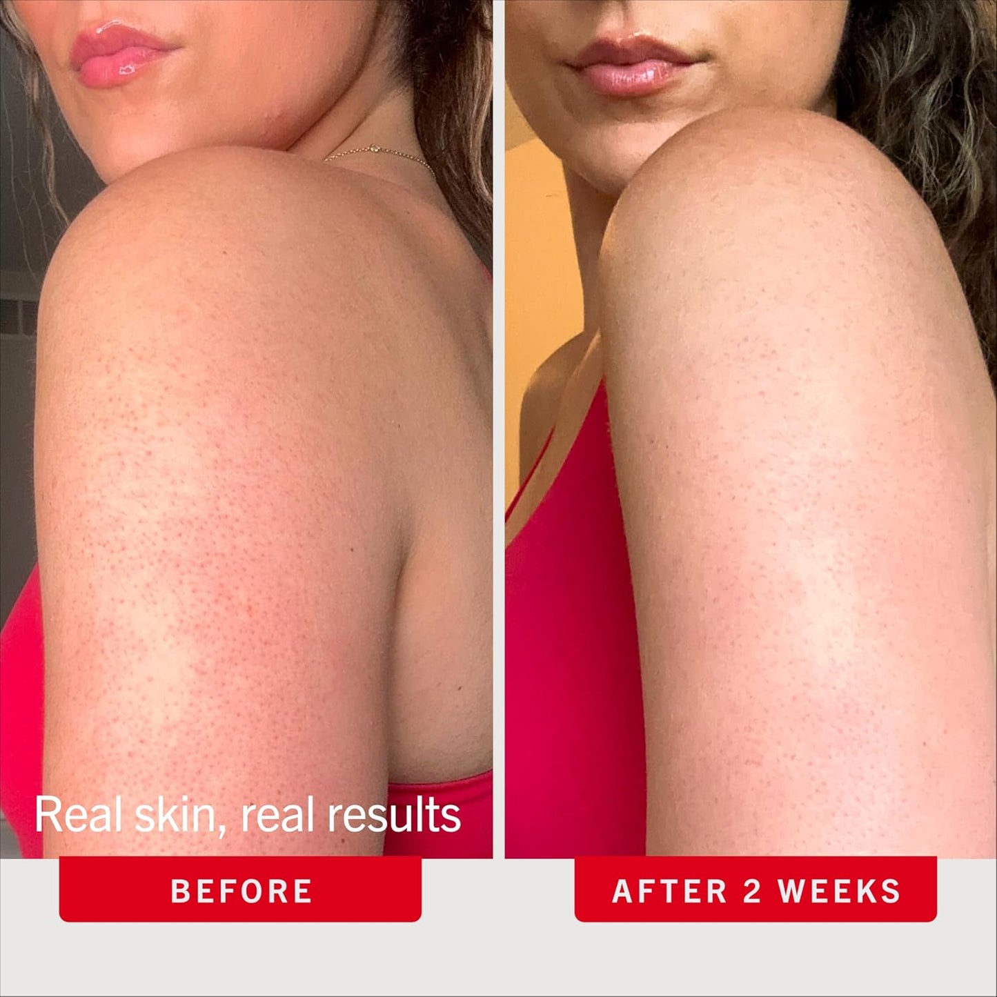 HotFirst Aid Beauty KP Bump Eraser Body Scrub with 10% AHA - Dermatologist-Tested Keratosis Pilaris Exfoliator - Support for Rough Bumps, Uneven Skin Texture & Strawberry Skin - Sensitive Skin