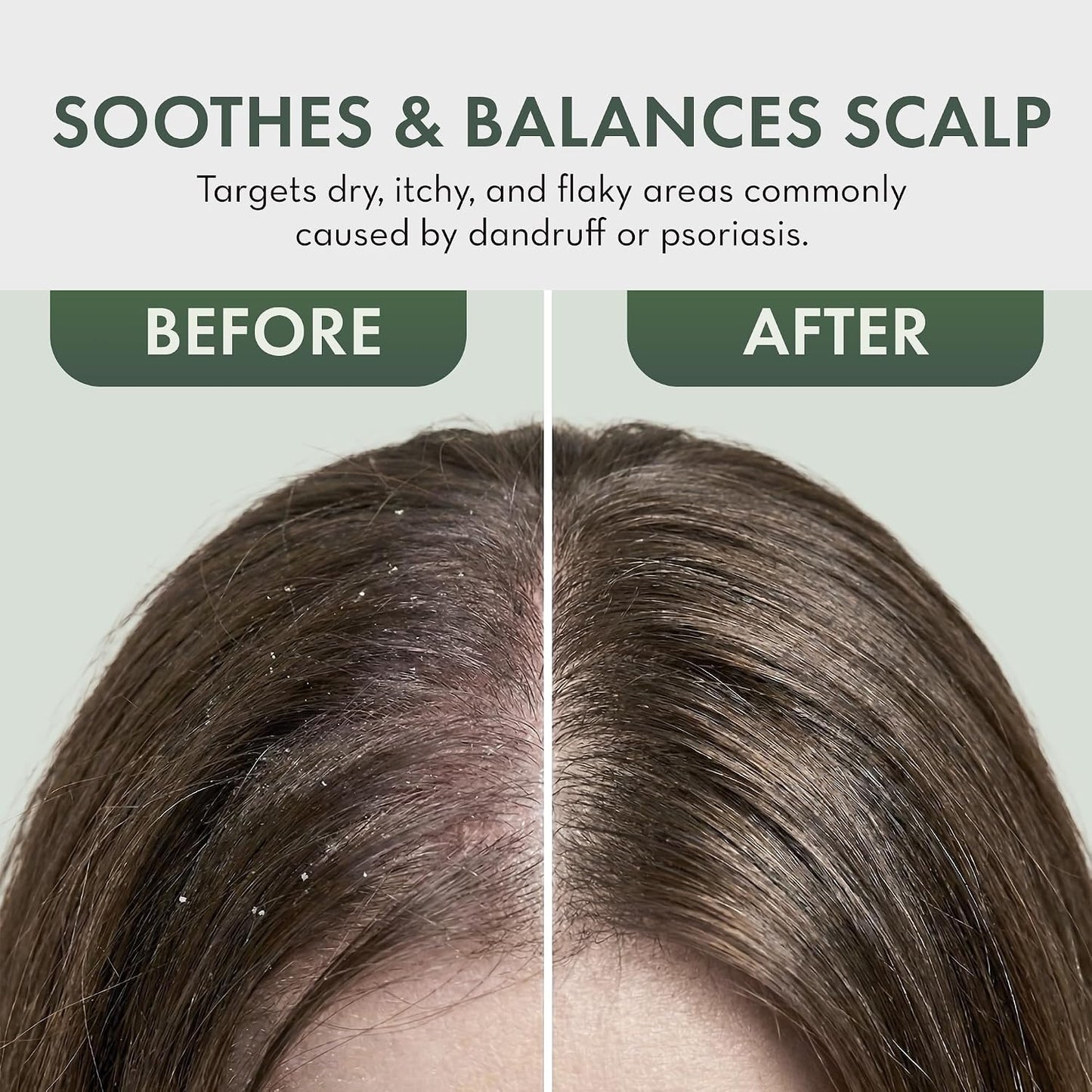 HotLeave In Conditioner Spray - Tea Tree Scalp Treatment | Anti-Dandruff and Dry & Itchy Scalp, Hydrating & Medicated Formula for Psoriasis and Scalp Care - Detangles & Nourishes Hair.