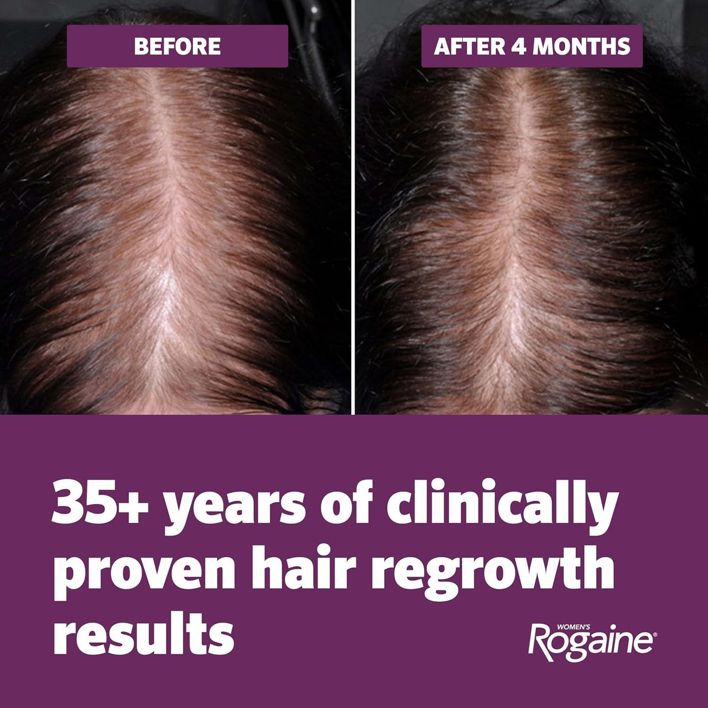 HotWomen's Rogaine Hair Growth Foam, 5% Topical Minoxidil, 4 Mo, 2x 2.11 Oz